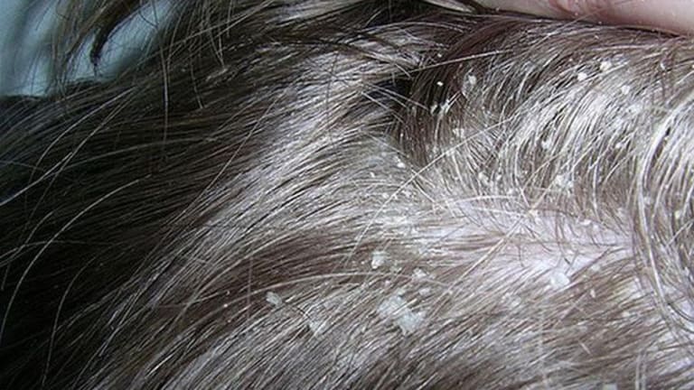 Trị sạch gàu, nấm tóc theo lời khuyên chuyên gia ✅ Liên hệ Mạnh Tiến 098.555.1486 để nhận thông tin chi tiết thêm về ✅ Trị sạch gàu, nấm tóc theo lời khuyên chuyên gia mà bạn đang tìm kiếm ✅.